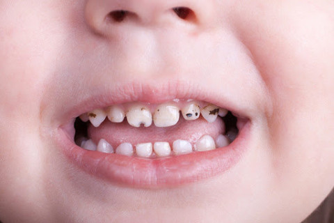 Жилд нэг хүүхдийн 3 шүд эмчлүүлэх зардлыг ЭМДС-аас даана